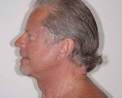 After Image: Patient # 78693 - left-side