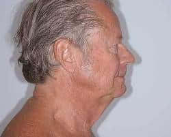 Before Image: Patient # 78693 - right-side