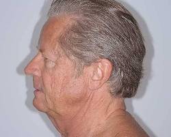 Before Image: Patient # 78693 - left-side
