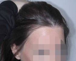 After Image: Patient # 36997 - right-front-oblique