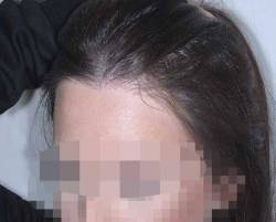After Image: Patient # 36997 - left-front-oblique