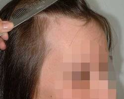 Before Image: Patient # 36997 - right-front-oblique