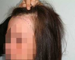 Before Image: Patient # 36997 - left-front-oblique