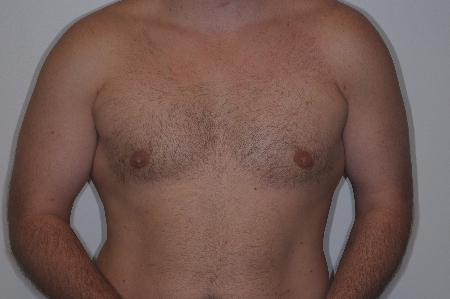 After Image: Patient # 55502 - front
