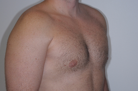 After Image: Patient # 55502 - right-front-oblique
