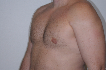 After Image: Patient # 55502 - left-front-oblique