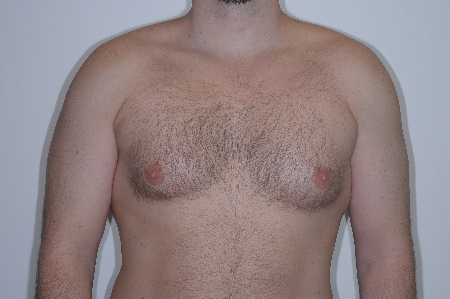 Before Image: Patient # 55502 - front