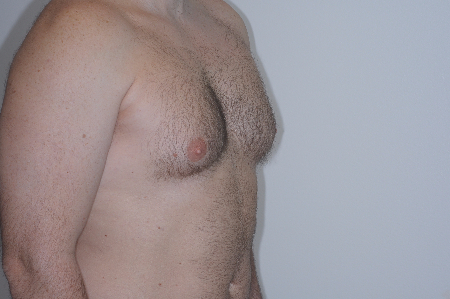 Before Image: Patient # 55502 - right-front-oblique