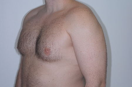Before Image: Patient # 55502 - left-front-oblique