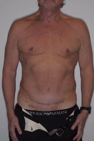 After Image: Patient # 76904 - front