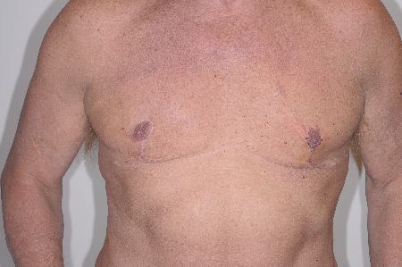 After Image: Patient # 76904 - front