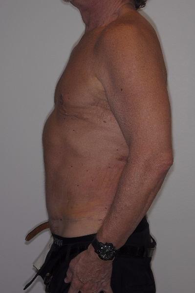 After Image: Patient # 76904 - left-side