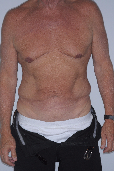 Before Image: Patient # 76904 - front