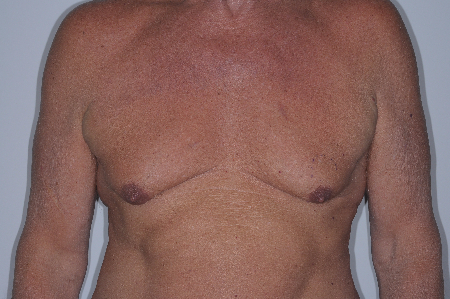 Before Image: Patient # 76904 - front