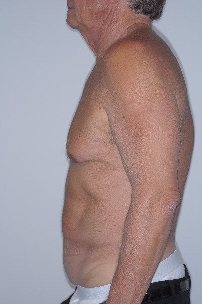 Before Image: Patient # 76904 - left-side