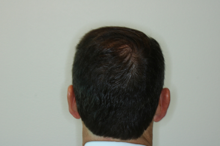 After Image: Patient # 93385 - back
