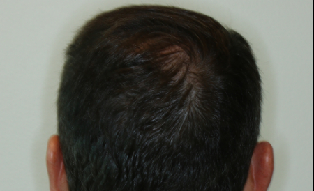 After Image: Patient # 93385 - back