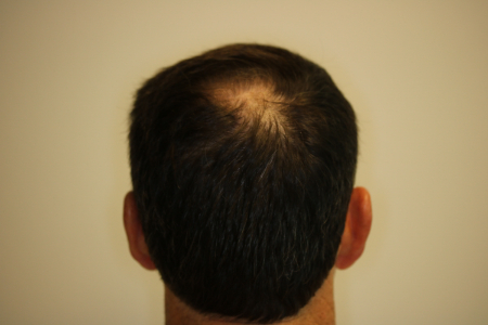 Before Image: Patient # 93385 - back