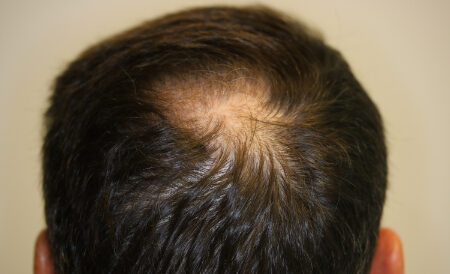 Before Image: Patient # 93385 - back