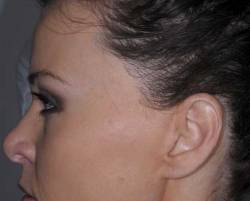 After Image: Patient # 45675 - left-side
