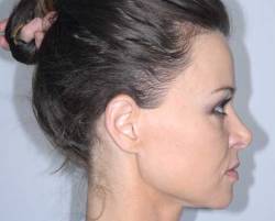 Before Image: Patient # 45675 - right-side