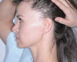 Before Image: Patient # 45675 - left-side