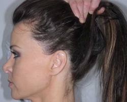 Before Image: Patient # 45675 - left-side