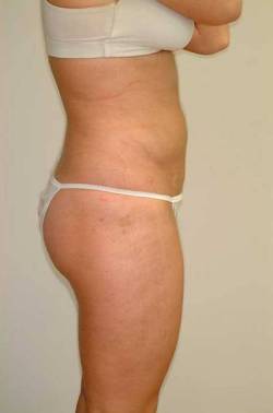 After Image: Patient # 54806 - right-side
