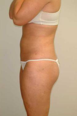 After Image: Patient # 54806 - left-side