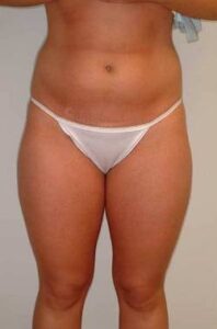 Before Image: Patient # 54806
