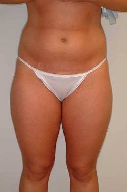 Before Image: Patient # 54806 - front