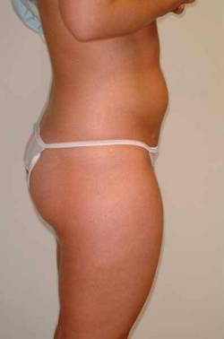 Before Image: Patient # 54806 - right-side