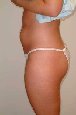 Before Image: Patient # 54806 - left-side
