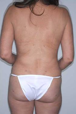 After Image: Patient # 57810 - back