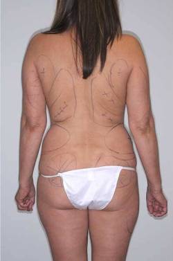 Before Image: Patient # 57810 - back