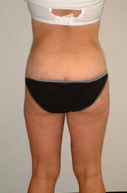 After Image: Patient # 63019 - back