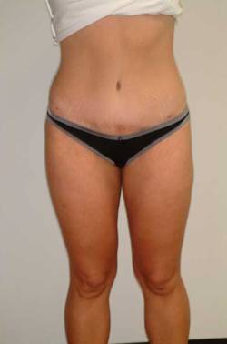 After Image: Patient # 63019 - front