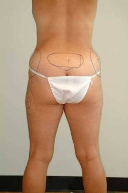 Before Image: Patient # 63019 - back