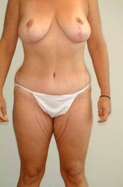 Before Image: Patient # 63019 - front