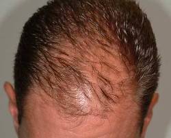 Before Image: Patient # 99004 - front