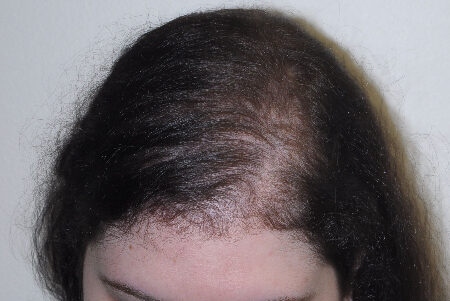 After Image: Patient # 63254 - front
