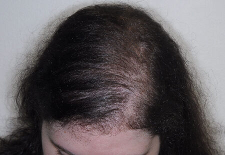 After Image: Patient # 63254 - front