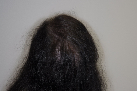 After Image: Patient # 63254 - back