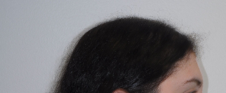 After Image: Patient # 63254 - right-side