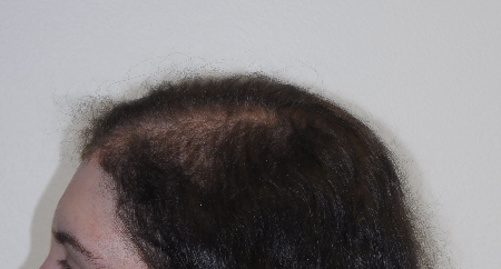 After Image: Patient # 63254 - left-side
