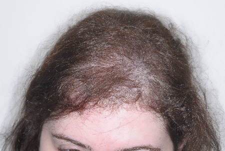Before Image: Patient # 63254 - front