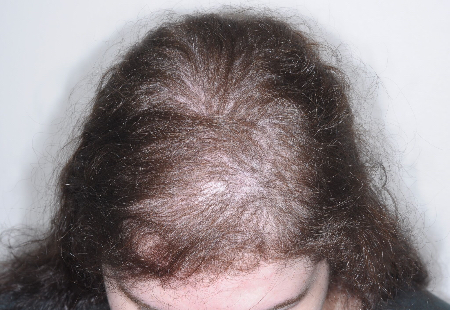 Before Image: Patient # 63254 - front