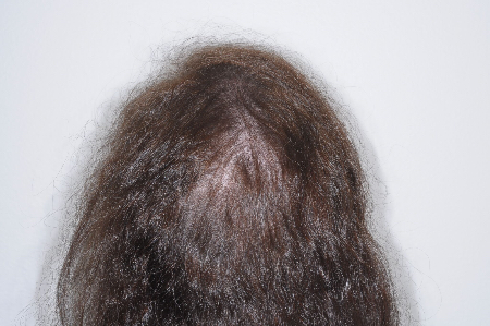 Before Image: Patient # 63254 - back