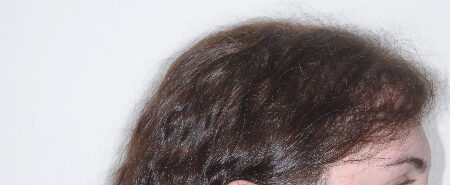 Before Image: Patient # 63254 - right-side