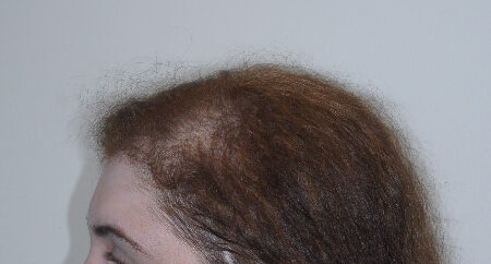 Before Image: Patient # 63254 - left-side